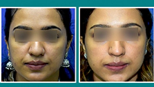 Skin Lightening Treatment Cost in Mumbai