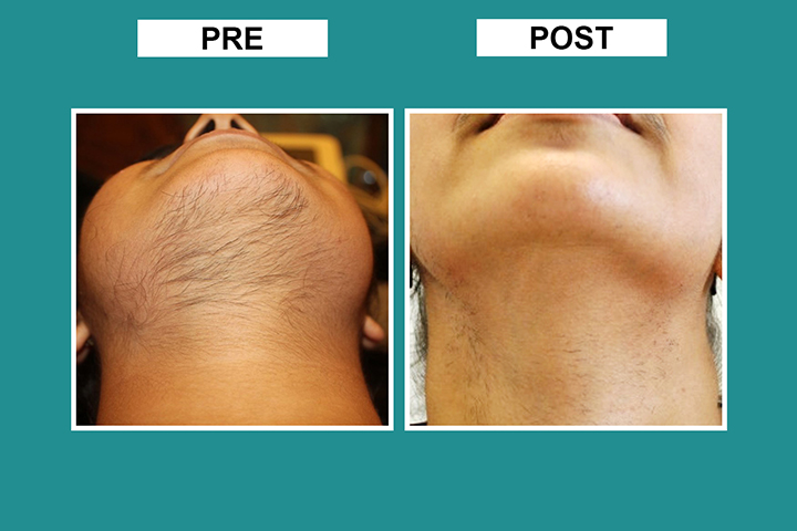 Cutis Skin Solution | Laser Hair Removal